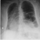 Hiatal hernia, upside-down stomach: X-ray - Plain radiograph